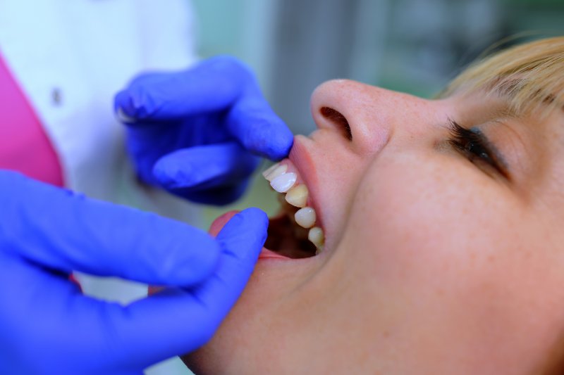 A dentist placing veneers on a woman’s teeth